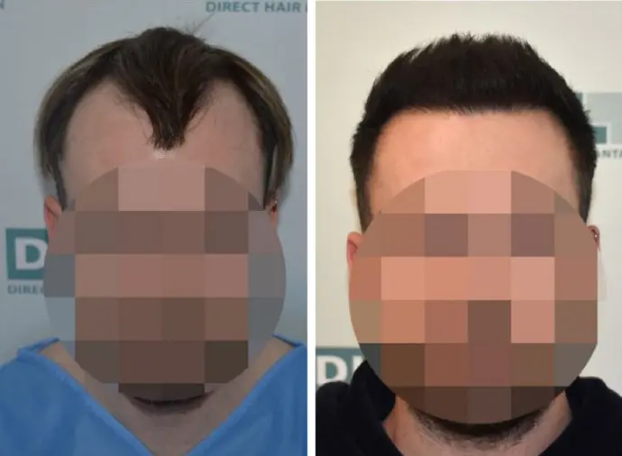 Before and after DHI hair transplant treatment on male patient