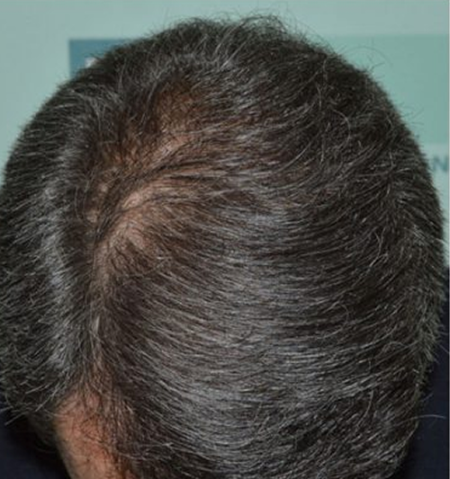 Patient showing hair restoration results after DHI hair transplant procedure in Panama
