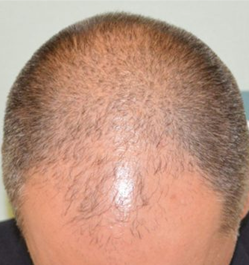 Patient with male pattern baldness before hair transplant procedure in Panama
