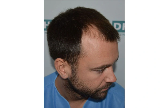 Profile view of patient prepared for hair restoration procedure